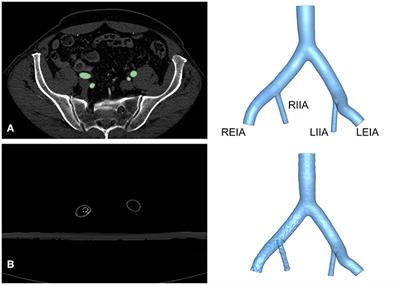 In-vitro and In-silico Haemodynamic Analyses of a Novel Embedded Iliac Branch Device